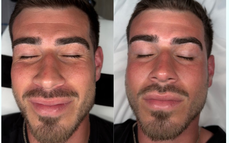 HydraFacial before and after at SlimFit