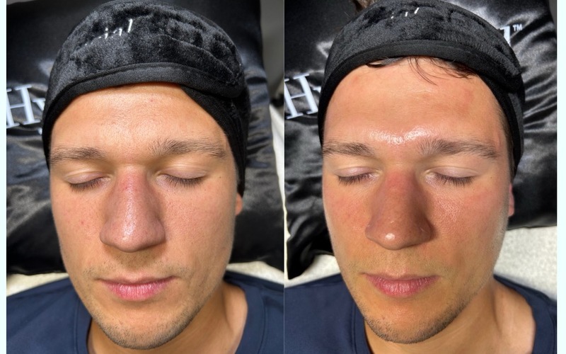 HydraFacial before and after at SlimFit