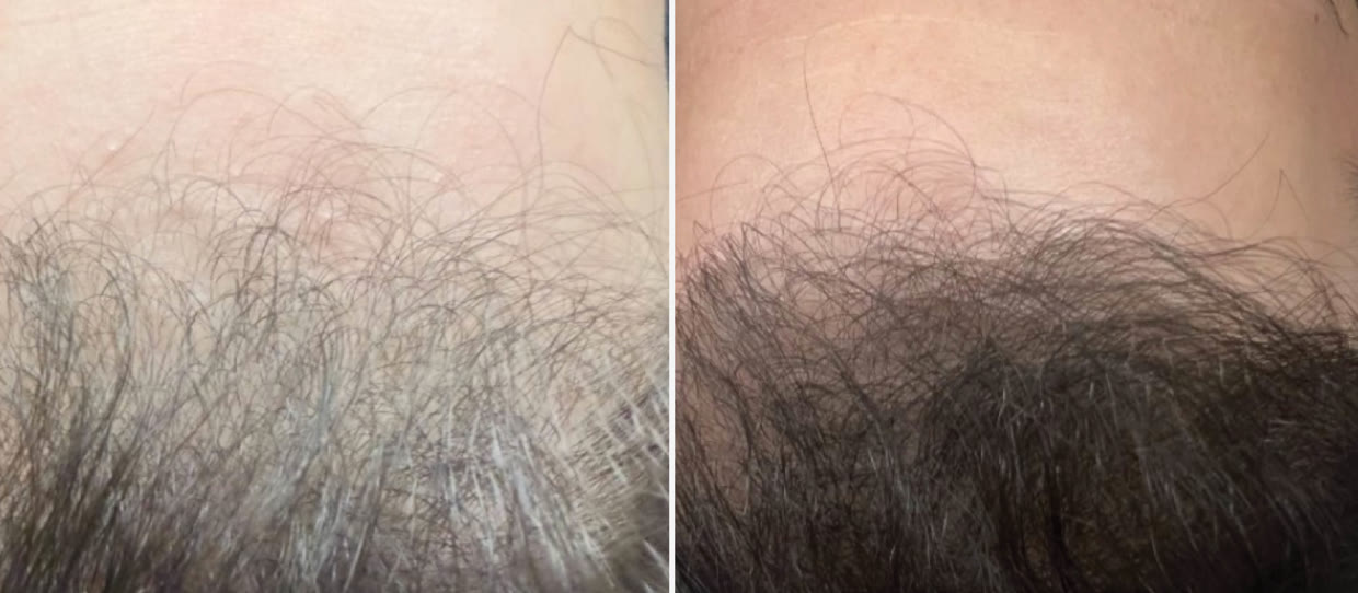 HydraScalp with Keravive hairline before and after, three months